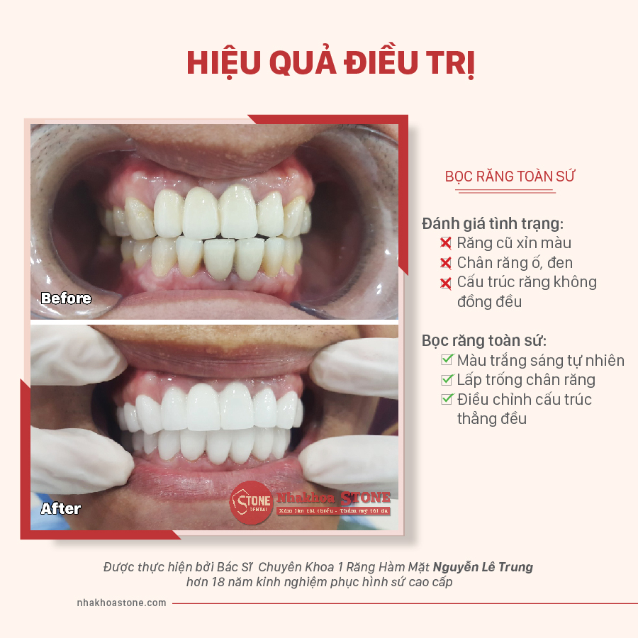 Hình ảnh trước và sau khi điều trị bọc răng sứ